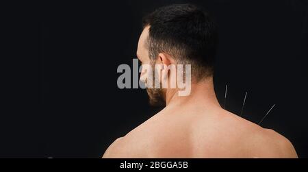 Vue rapprochée depuis le dos d'un patient masculin avec aiguilles d'acupuncture dans son épaule sur fond noir. Acupuncture Banque D'Images