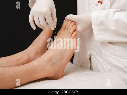 Acupuncture du pied humain. Aiguilles d'acupuncture près. Traitement d'acupuncture pour la douleur chronique Banque D'Images