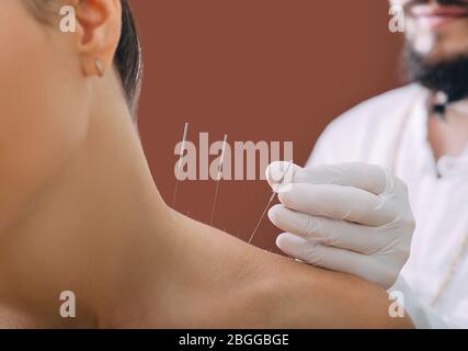 Aiguilles pour l'acupuncture dans l'épaule d'une femme gros plan sur un fond brun. Un réflexologue faisant très précisément de l'acupuncture Banque D'Images