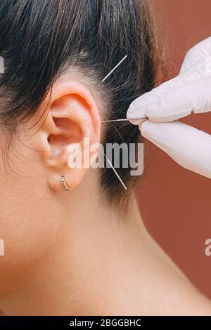 Traitement de nombreuses maladies par acupuncture de l'oreille. Acupuncturist traite une maladie de patients avec acupuncture à des points spéciaux sur son oreille. Banque D'Images