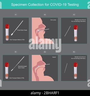 Prélèvement d'échantillons pour les tests COVID-19. Méthode utilisée milieu de transport viral (VTM) pour la collecte des sécrétions d'échantillons pour les personnes à risque virus COVID-19. Illustration de Vecteur