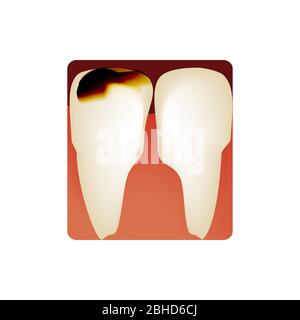 Caries dentaires. Carie dentaire. Infos sur les caries. Illustration vectorielle sur un arrière-plan isolé. Illustration de Vecteur