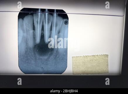 Photo du film radiographique des dents diagnostiquées dans la clinique dentaire de Bangkok en Thaïlande; Thaïlande le 1er décembre 2018 Banque D'Images