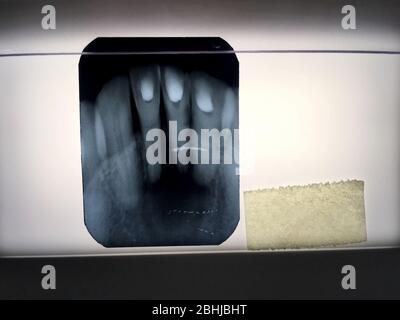 Photo du film radiographique des dents diagnostiquées dans la clinique dentaire de Bangkok en Thaïlande; Thaïlande le 1er décembre 2018 Banque D'Images