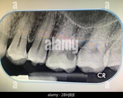 Photo du film radiographique des dents diagnostiquées dans la clinique dentaire de Bangkok en Thaïlande; Thaïlande le 1er décembre 2018 Banque D'Images