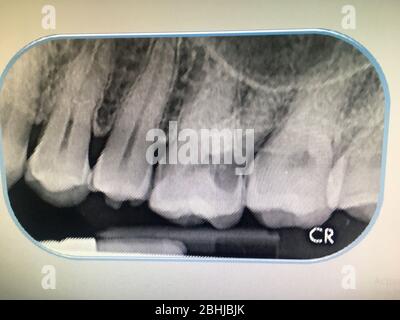 Photo du film radiographique des dents diagnostiquées dans la clinique dentaire de Bangkok en Thaïlande; Thaïlande le 1er décembre 2018 Banque D'Images