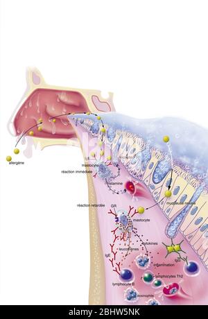 Congestion nasale, détails de la muqueuse nasale, allergène, réaction allergique, traitements. Phase clinique de la rhinite allergique au contact de l'allerge Banque D'Images