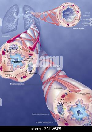 Asthme : bronchiole normale, bronchiole asthmatique avec bronchoconstriction, hypersécrétion, traitements. Représentation des poumons avec le t bronchique Banque D'Images