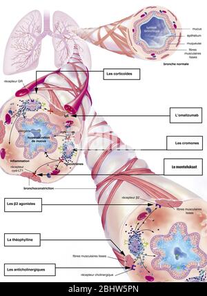 Asthme, bronchiole normale, bronchiole asthmatique avec bronchoconstriction, hypersécrétion, traitements. Représentation des poumons avec le t bronchique Banque D'Images