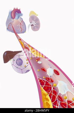 Infarctus du myocarde, artère coronaire avec thrombus, plaques athéromateuses, traitements. Les plaques athéromateuses (jaunes) dans le mur de la coronaropathie Banque D'Images