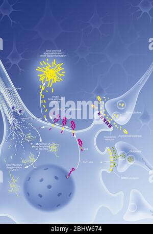 Processus de dégénérescence neurofibrillaire avec neurone, plaque sénile, des traitements. Neurone dans le système nerveux central affectées par clivage anormal de l'APP Banque D'Images