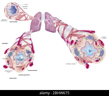 Asthme, bronchiole normale, bronchiole asthmatique avec bronchoconstriction, hypersécrétion, traitements. Représentation des poumons avec le t bronchique Banque D'Images