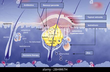 Acné autour du follicule pileux avec inflammation, hypersécrétion sébacée, hyperkératinisation. Section cutanée de l'épiderme et du derme. Cheveux normaux Banque D'Images