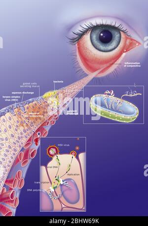 Conjonctivite infectieuse et ses traitements. Vue d'un oeil avec inflammation de la conjonctive. Zoom sur la conjonctive avec de haut en bas 1 b Banque D'Images