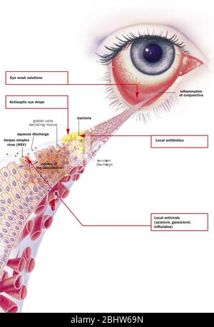 Conjonctivite infectieuse et ses traitements. Vue d'un oeil avec inflammation de la conjonctive. Zoom sur la conjonctive avec de haut en bas 1 b Banque D'Images