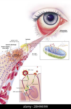 Conjonctivite infectieuse et ses traitements. Vue d'un oeil avec inflammation de la conjonctive. Zoom sur la conjonctive avec de haut en bas 1 b Banque D'Images