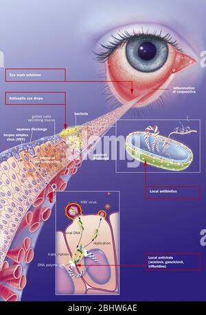 Conjonctivite infectieuse et ses traitements. Vue d'un oeil avec inflammation de la conjonctive. Zoom sur la conjonctive avec de haut en bas 1 b Banque D'Images