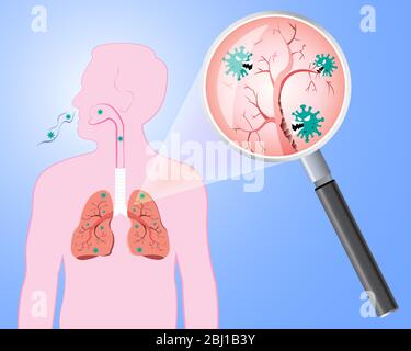 Endommagé par les cellules de Coronavirus avec loupe inspectant les affectés sur le poumon. COVID-19 avec le visage effrayant et mal mangeant le poumon. Concept 2019-nCoV Illustration de Vecteur