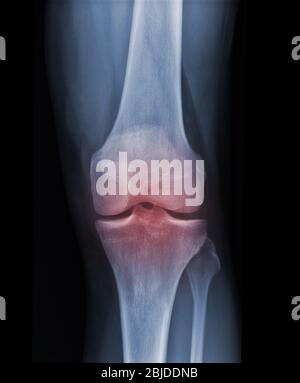 La radiographie du genou à rayons X montre l'état de blessure Banque D'Images