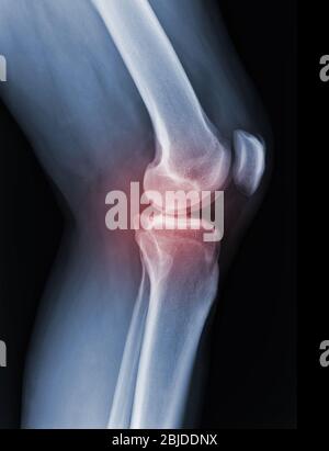 La radiographie du genou à rayons X montre l'état de blessure Banque D'Images