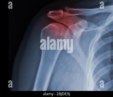 La radiographie des épaules à rayons X montre l'état de blessure Banque D'Images