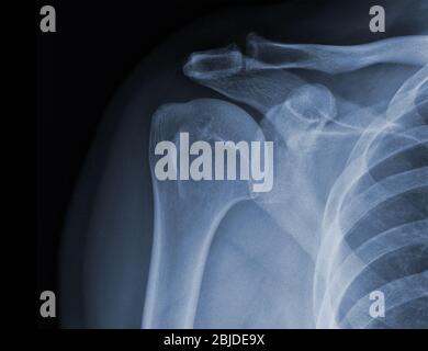 La radiographie des épaules à rayons X montre l'état de blessure Banque D'Images