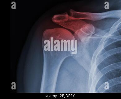 La radiographie des épaules à rayons X montre l'état de blessure Banque D'Images