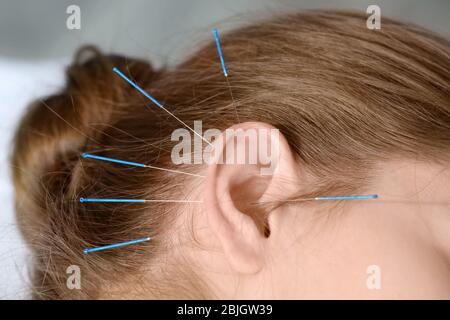 Jeune femme en traitement d'acupuncture, closeup Banque D'Images