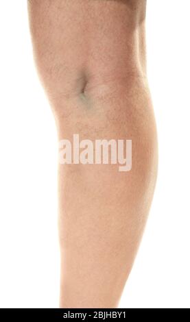 Jambe humaine sur fond blanc, closeup. Concept varices Banque D'Images