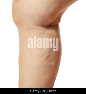 Jambe humaine sur fond blanc, closeup. Concept varices Banque D'Images