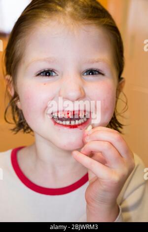 Une petite fille de cinq ans qui est heureuse et ravie, ayant tiré une de ses dents de lait, une incisive de dessus lâche. La plaie est en train de saigner avec du sang pendant un moment après. (119) ROYAUME-UNI Banque D'Images