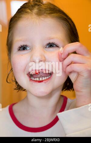 Une petite fille de cinq ans qui est heureuse et ravie, ayant tiré une de ses dents de lait, une incisive de dessus lâche. La plaie est en train de saigner avec du sang pendant un moment après. (119) ROYAUME-UNI Banque D'Images