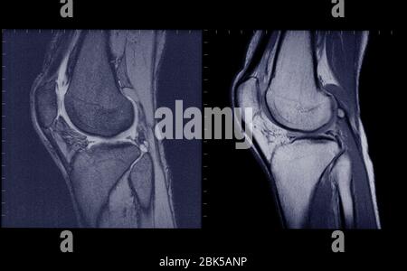 Vue latérale des articulations du genou, IRM. Banque D'Images