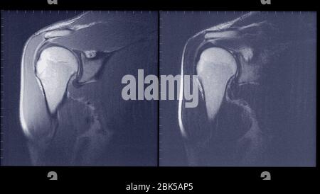 Articulation thoracique, IRM. Banque D'Images