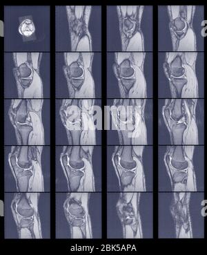Acquisitions multiples de l'articulation du genou, IRM. Banque D'Images