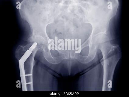 Bassin avec os de jambe plaquée, rayons X. Banque D'Images