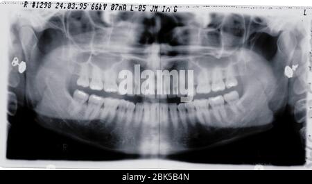 Dents et mâchoire, rayons X. Banque D'Images
