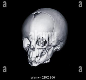 Image de la tête du bébé, acquisition TDM (Computed tomography). Banque D'Images