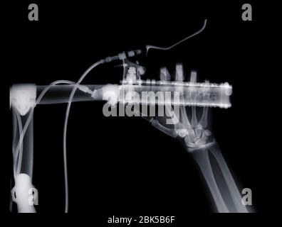 Frein à main humain sur vélo, rayons X. Banque D'Images