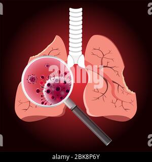 Endommagé par les cellules de Coronavirus avec loupe inspectant les affectés sur le poumon. Concept 2019-nCoV. Illustration de Vecteur