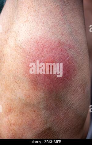 Cochez la case morsure sur le bras, photos marchetées, photos pour hommes, photos de la maladie de Lyme, adulte, Photos de Bug Bite, photos de taureaux, Tick - Photos d'animaux, photos d'insectes, Bois Banque D'Images
