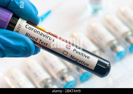 Tenir les patients à la main pour tester des échantillons de sang pour l'éclosion du coronavirus (COVID-19) en laboratoire, Nouveau coronavirus 2019-nCoV. Banque D'Images