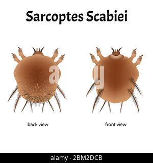 Sarcoptes scabiei. Gale. Maladie sexuellement transmissible. Infographies. Illustration sur un arrière-plan isolé. Illustration de Vecteur