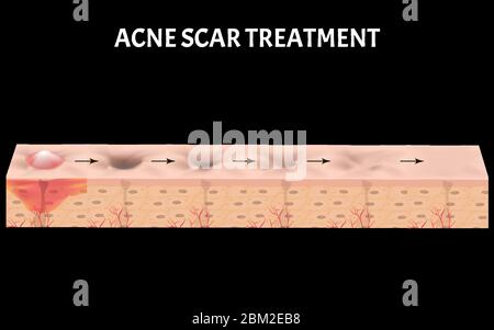 Cicatrices atrophiques. Cicatrice d'acné. La structure anatomique de la peau avec l'acné. Illustration vectorielle. Illustration de Vecteur