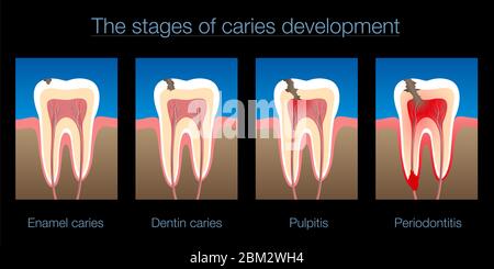 Carie dentaire, stades de développement de caries, carie émaillée et dentine, pulpite et parodontite - illustration sur fond noir. Banque D'Images