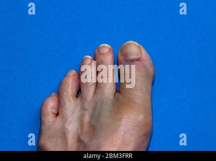 Gros orteil cassé (fracturé). Banque D'Images