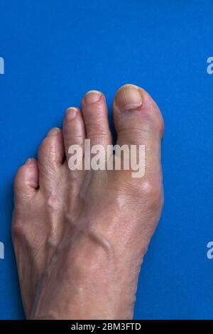 Gros orteil cassé (fracturé). Banque D'Images