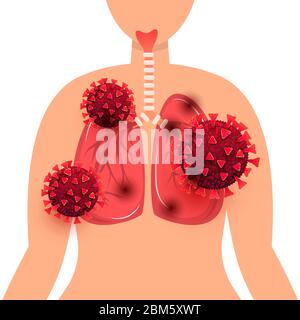 Coronavirus de la maladie pulmonaire. Infection à coronavirus des cellules pulmonaires humaines dans le corps humain isolé sur fond blanc. Concept Covid 19, illustration vectorielle Illustration de Vecteur