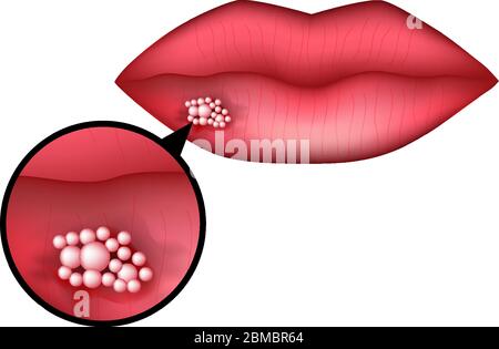 L'herpès sur la lèvre. L'infographie. Vector illustration sur fond isolé. Illustration de Vecteur