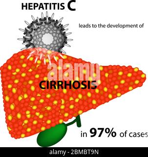 L'hépatite C entraîne le développement de la cirrhose dans 97 % des cas. Infographies. Illustration vectorielle sur un arrière-plan isolé. Illustration de Vecteur